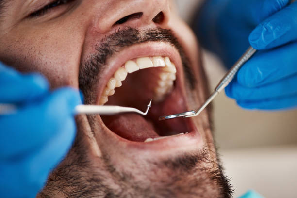 Best Emergency Treatment for Dental Infections or Abscesses in Cambridge City, IN